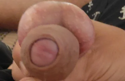 The Great Transformation of Phimosis Elastica.