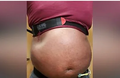 N2o Belly Inflation